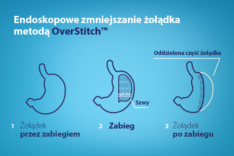 Endoskopowe zmniejszenie żołądka z wykorzystaniem zestawu OverStitch™: proces operacji - chudniemy.pl